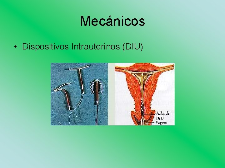 Mecánicos • Dispositivos Intrauterinos (DIU) 