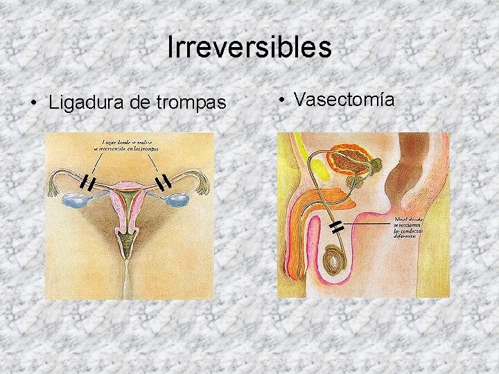 Irreversibles • Ligadura de trompas • Vasectomía 