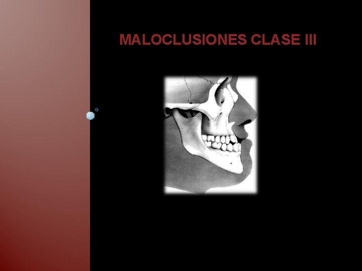 MALOCLUSIONES CLASE III 