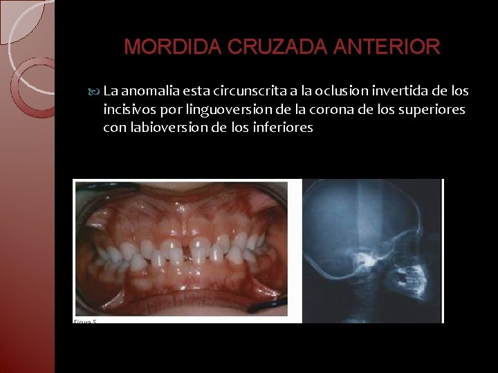 MORDIDA CRUZADA ANTERIOR La anomalia esta circunscrita a la oclusion invertida de los incisivos