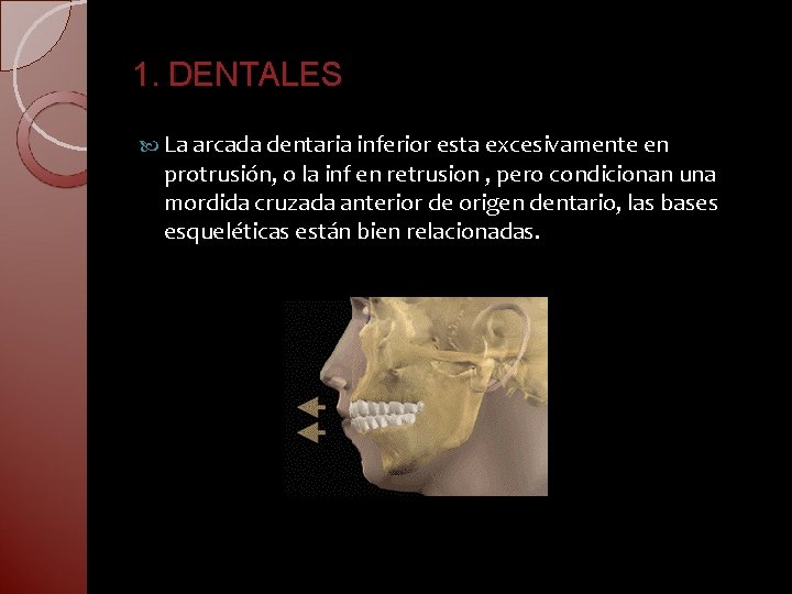 1. DENTALES La arcada dentaria inferior esta excesivamente en protrusión, o la inf en