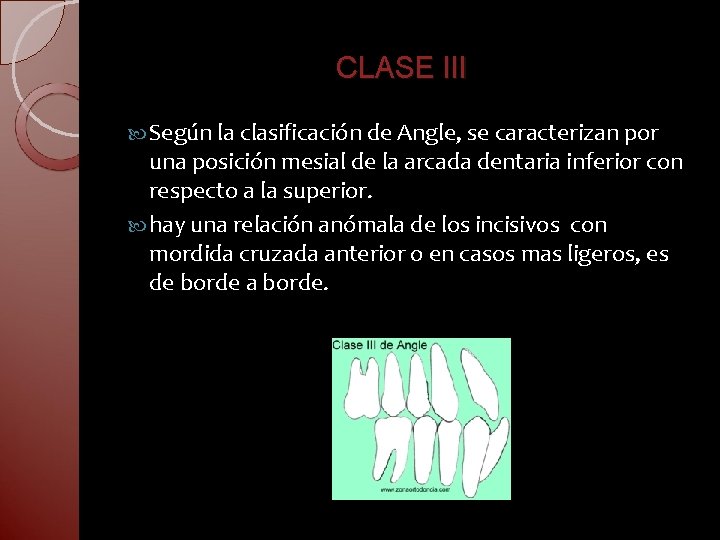 CLASE III Según la clasificación de Angle, se caracterizan por una posición mesial de