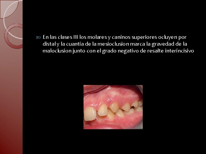  En las clases III los molares y caninos superiores ocluyen por distal y