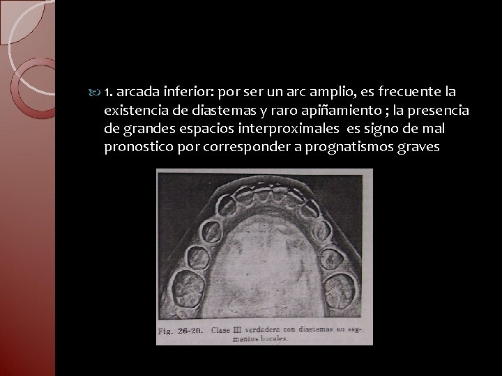  1. arcada inferior: por ser un arc amplio, es frecuente la existencia de