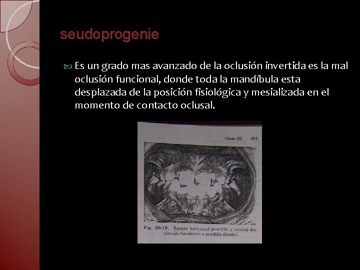 seudoprogenie Es un grado mas avanzado de la oclusión invertida es la mal oclusión