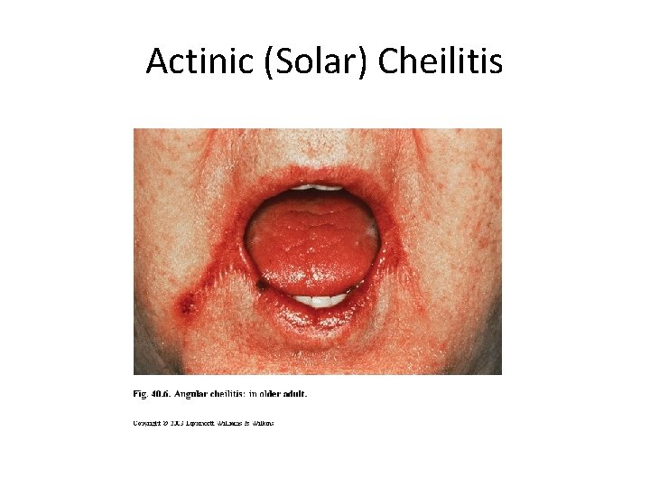 Actinic (Solar) Cheilitis 