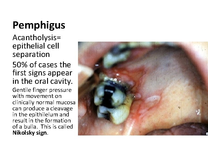 Pemphigus Acantholysis= epithelial cell separation 50% of cases the first signs appear in the