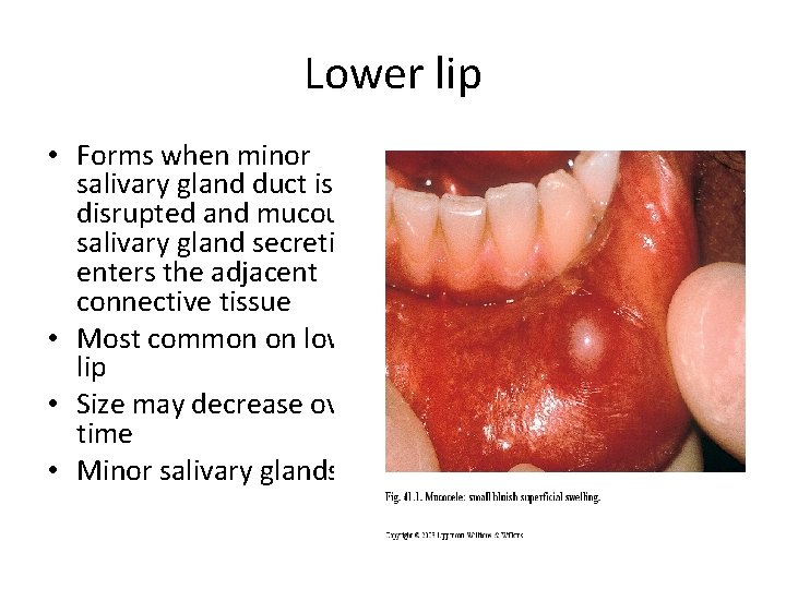 Lower lip • Forms when minor salivary gland duct is disrupted and mucous salivary