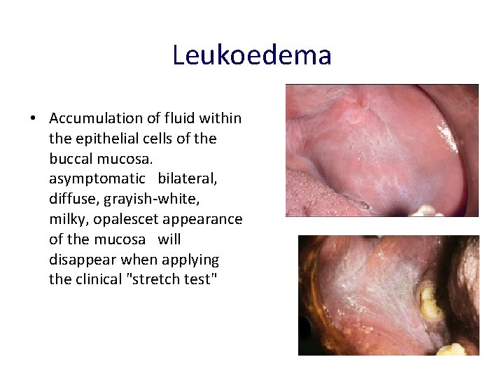 Leukoedema • Accumulation of fluid within the epithelial cells of the buccal mucosa. asymptomatic