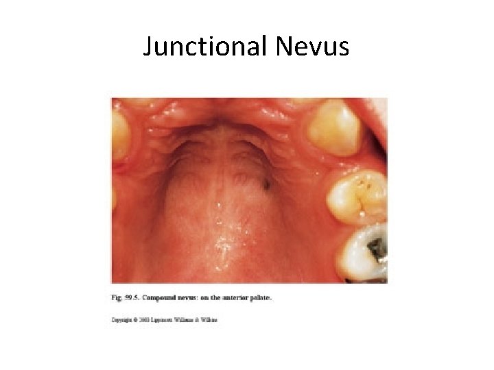 Junctional Nevus 