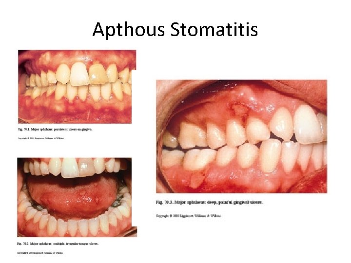 Apthous Stomatitis 