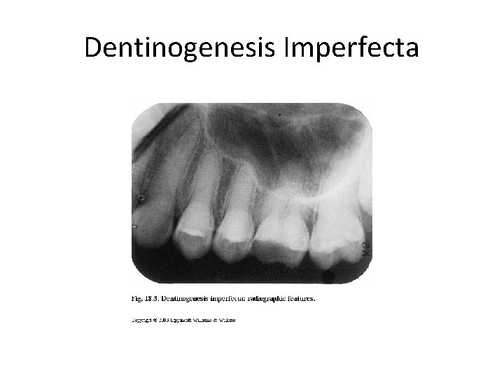 Dentinogenesis Imperfecta 