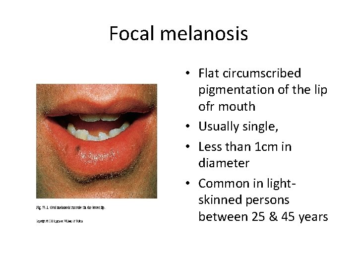 Focal melanosis • Flat circumscribed pigmentation of the lip ofr mouth • Usually single,