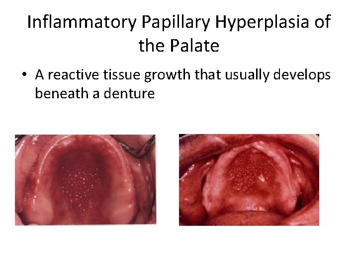 Inflammatory Papillary Hyperplasia of the Palate • A reactive tissue growth that usually develops