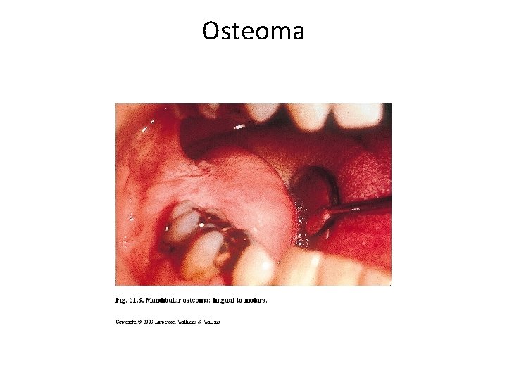 Osteoma 