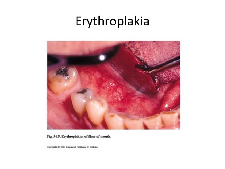 Erythroplakia 
