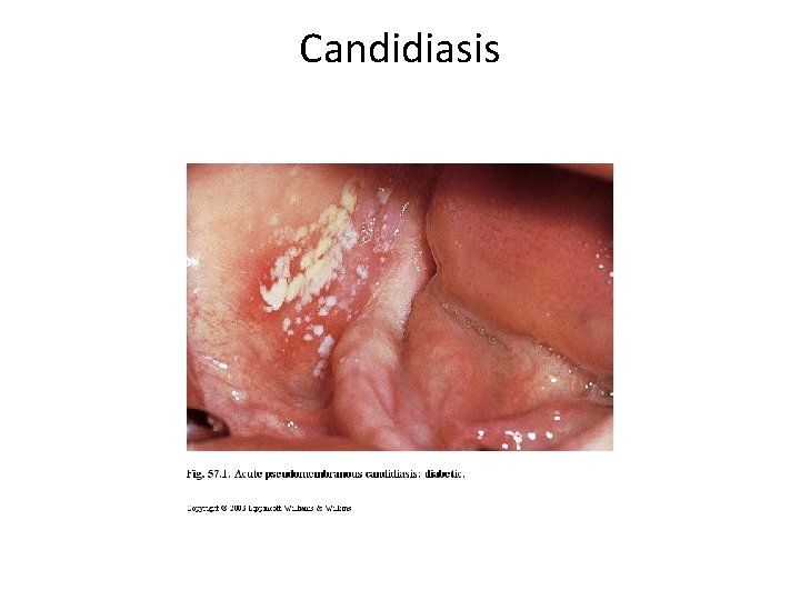 Candidiasis 