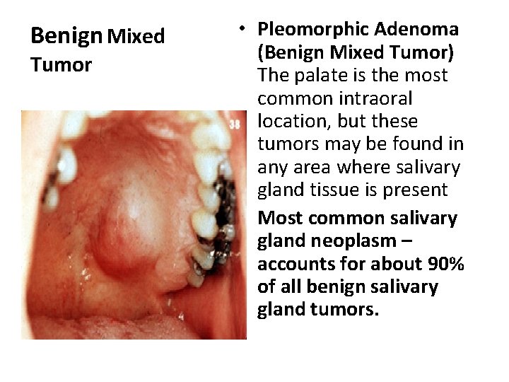 Benign Mixed Tumor • Pleomorphic Adenoma (Benign Mixed Tumor) The palate is the most