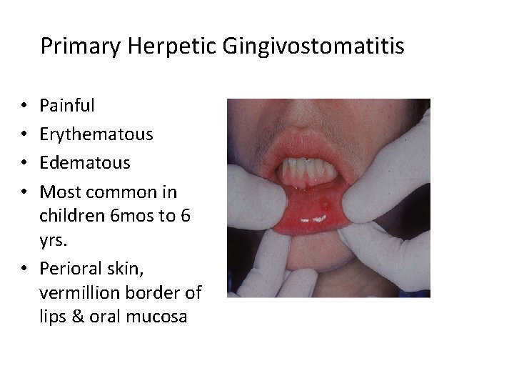 Primary Herpetic Gingivostomatitis Painful Erythematous Edematous Most common in children 6 mos to 6