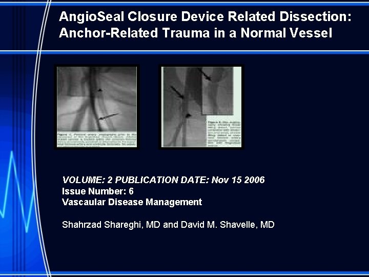 Angio. Seal Closure Device Related Dissection: Anchor-Related Trauma in a Normal Vessel VOLUME: 2