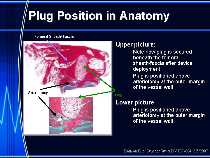 Plug Position in Anatomy Femoral Sheath/ Fascia Upper picture: – Note how plug is
