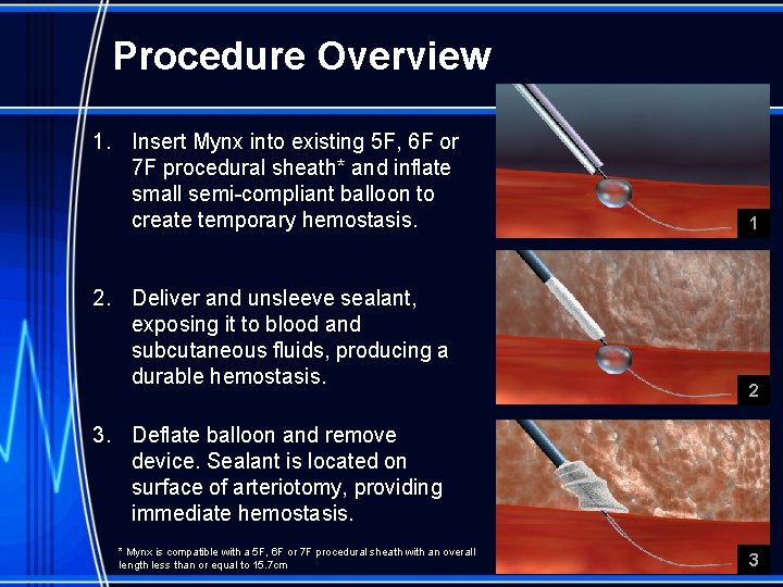 Procedure Overview 1. Insert Mynx into existing 5 F, 6 F or 7 F