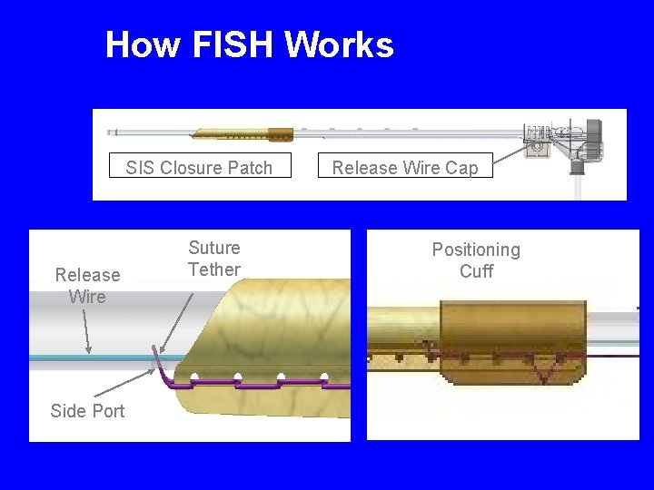 How FISH Works SIS Closure Patch Release Wire Side Port Suture Tether Release Wire