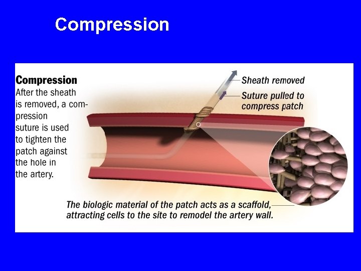 Compression 