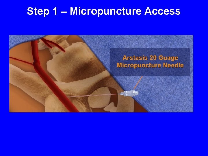 Step 1 – Micropuncture Access 