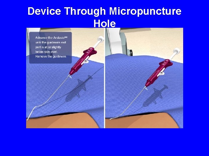 Device Through Micropuncture Hole 
