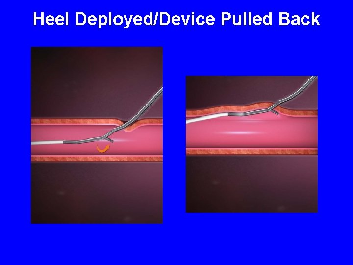 Heel Deployed/Device Pulled Back 