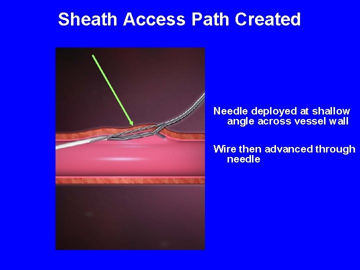 Sheath Access Path Created Needle deployed at shallow angle across vessel wall Wire then