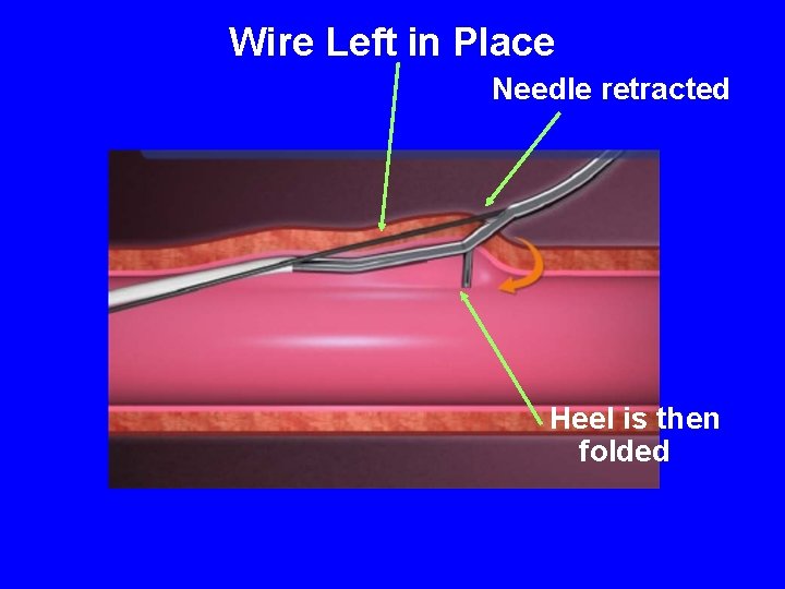 Wire Left in Place Needle retracted Heel is then folded 