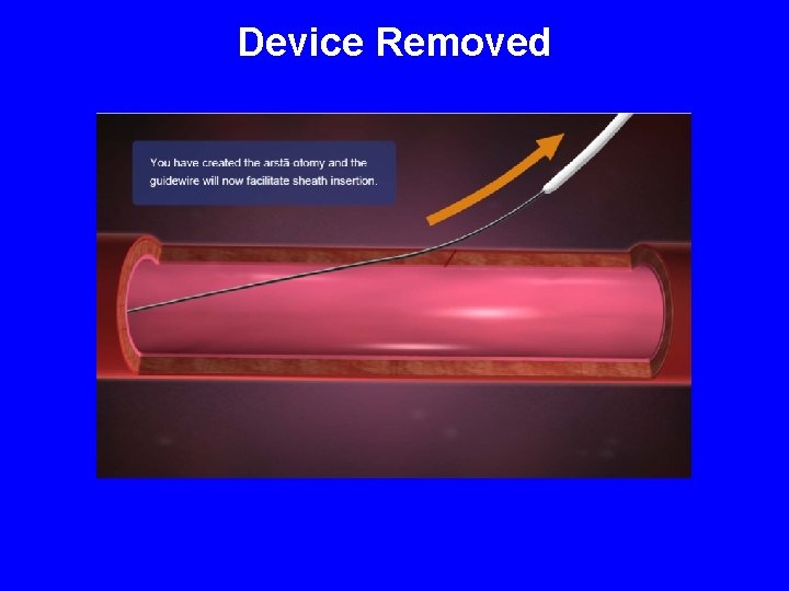 Device Removed 