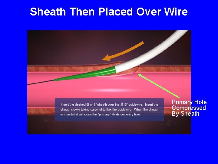 Sheath Then Placed Over Wire Primary Hole Compressed By Sheath 