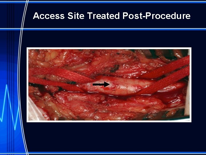 Access Site Treated Post-Procedure 