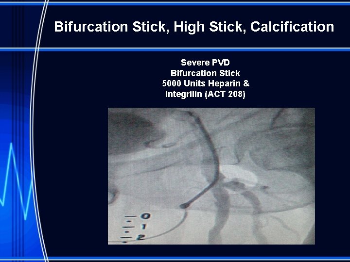  Bifurcation Stick, High Stick, Calcification Severe PVD Bifurcation Stick 5000 Units Heparin &