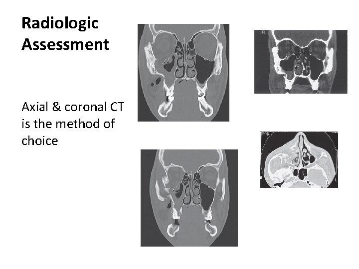Radiologic Assessment Axial & coronal CT is the method of choice 