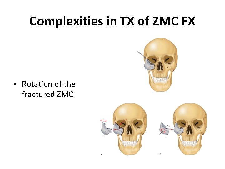 Complexities in TX of ZMC FX • Rotation of the fractured ZMC 