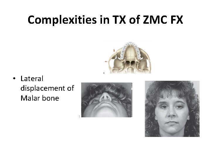 Complexities in TX of ZMC FX • Lateral displacement of Malar bone 