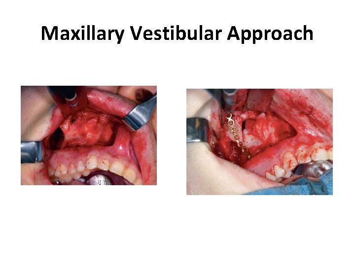 Maxillary Vestibular Approach 