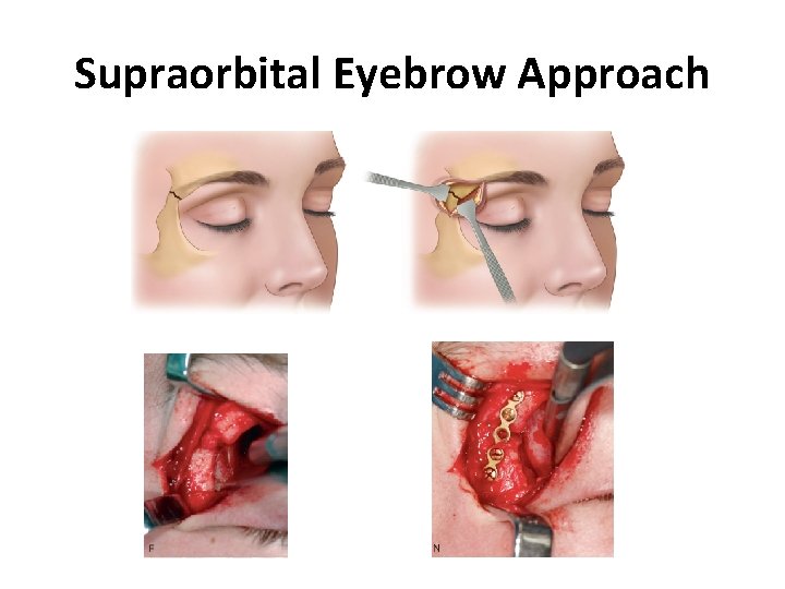 Supraorbital Eyebrow Approach 