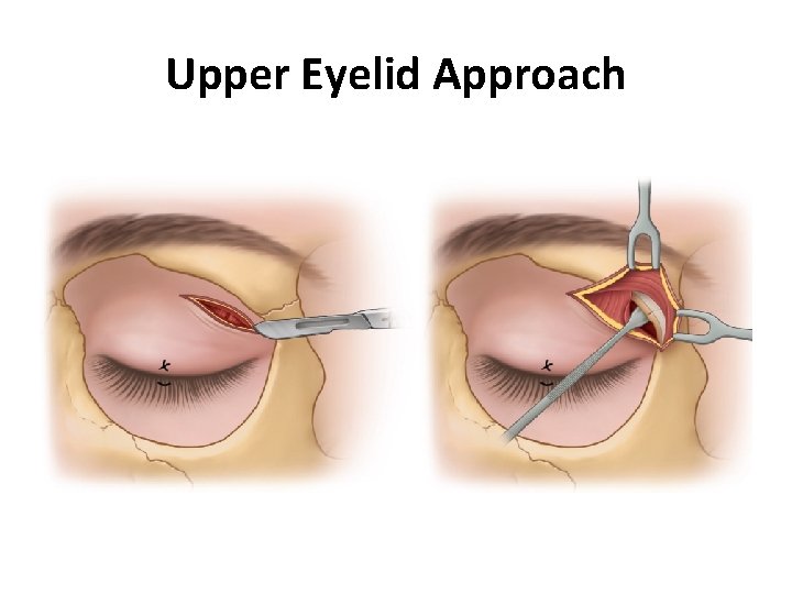 Upper Eyelid Approach 