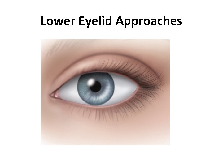 Lower Eyelid Approaches 