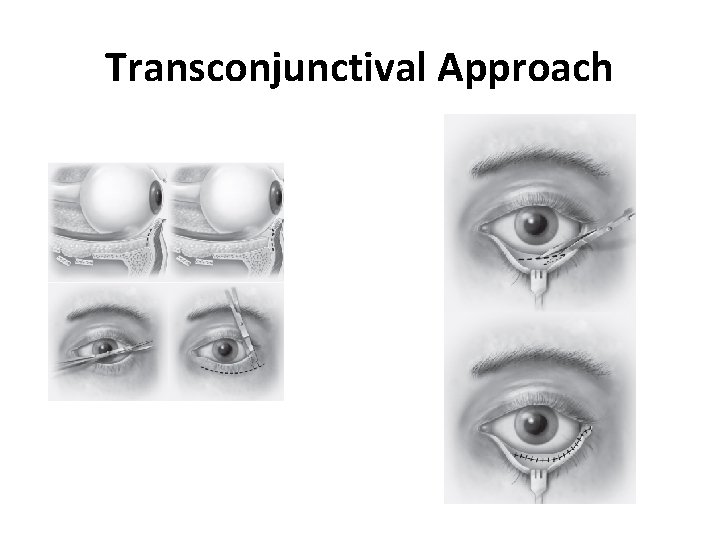 Transconjunctival Approach 