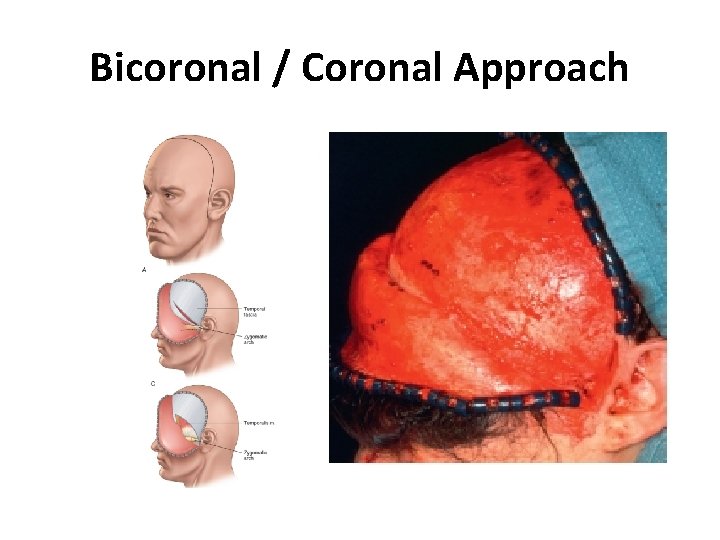 Bicoronal / Coronal Approach 