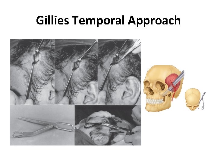 Gillies Temporal Approach 