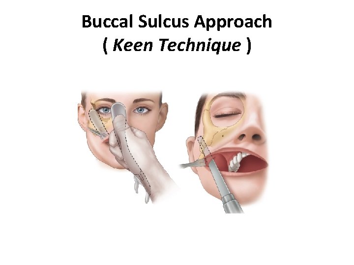 Buccal Sulcus Approach ( Keen Technique ) 