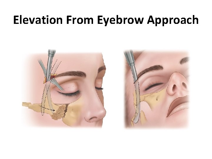 Elevation From Eyebrow Approach 