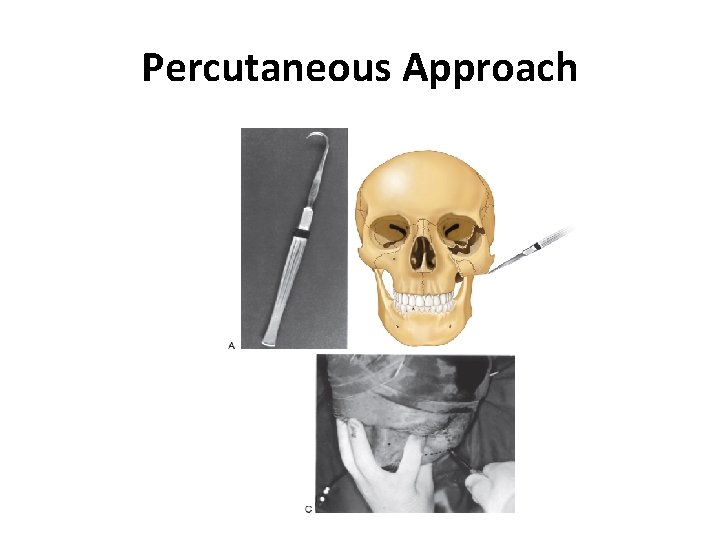 Percutaneous Approach 